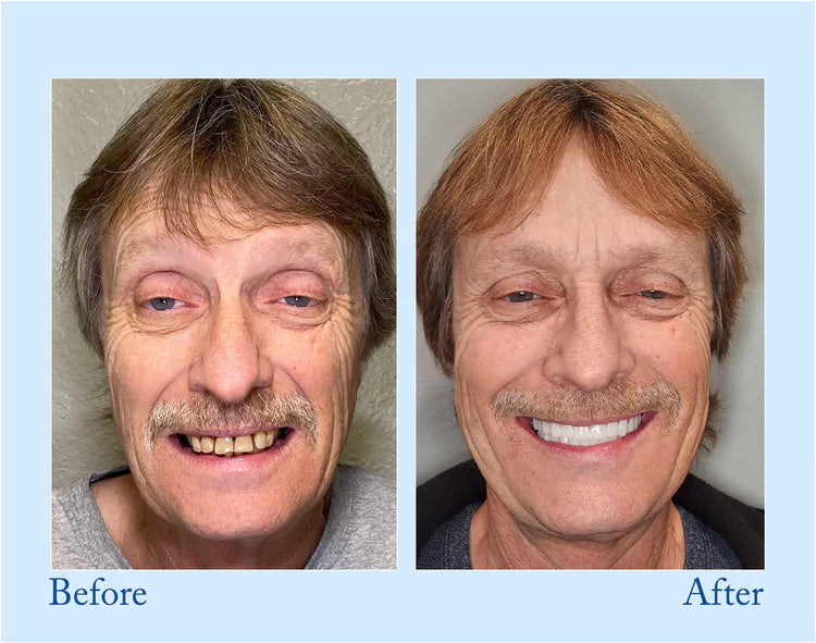 đ BBOJI⢠Fluoride-Free Hydroxyapatite Toothpaste đ Naturally Brighter Smiles