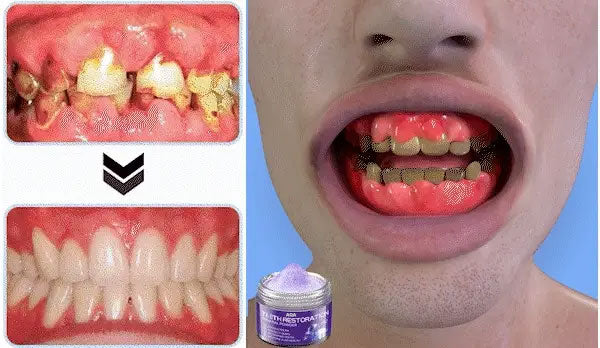 AQA™ TeethRestoration Mineral Powder🦷(CDA recommended) (🎁Flash Sale - Don’t Miss Out)