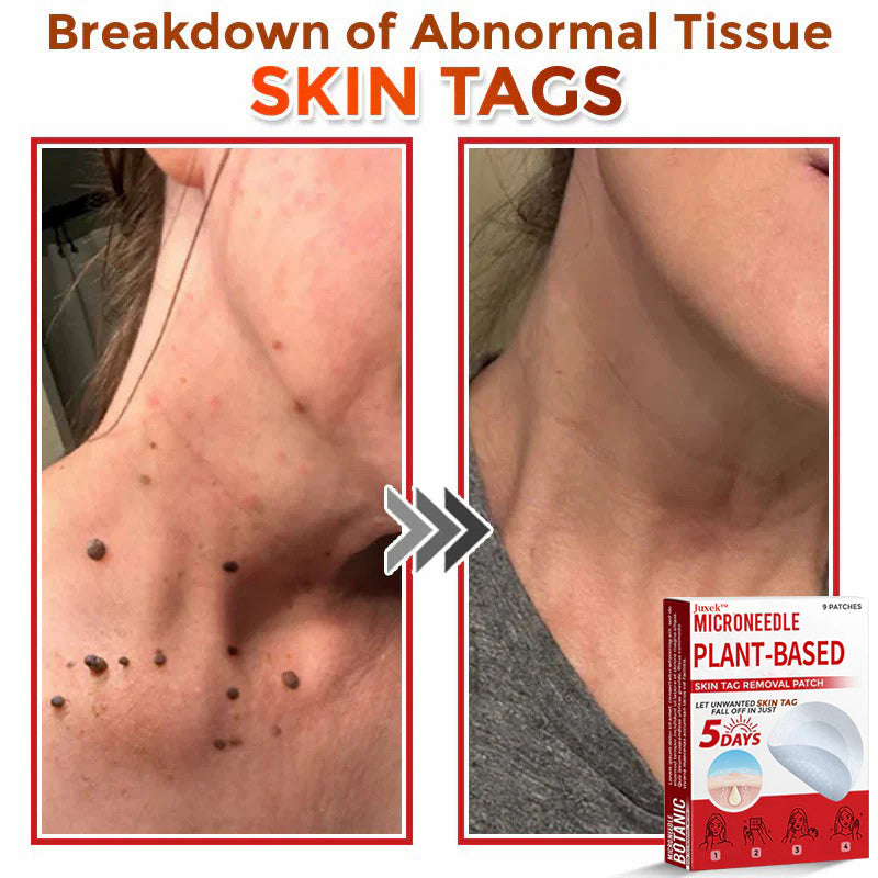 💯Juxek™ MicroNeedle Plant-based Skin Tag Removal Patch 🇺🇸 Made in the USA