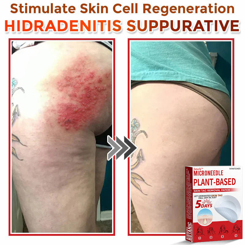 💯Juxek™ MicroNeedle Plant-based Skin Tag Removal Patch 🇺🇸 Made in the USA