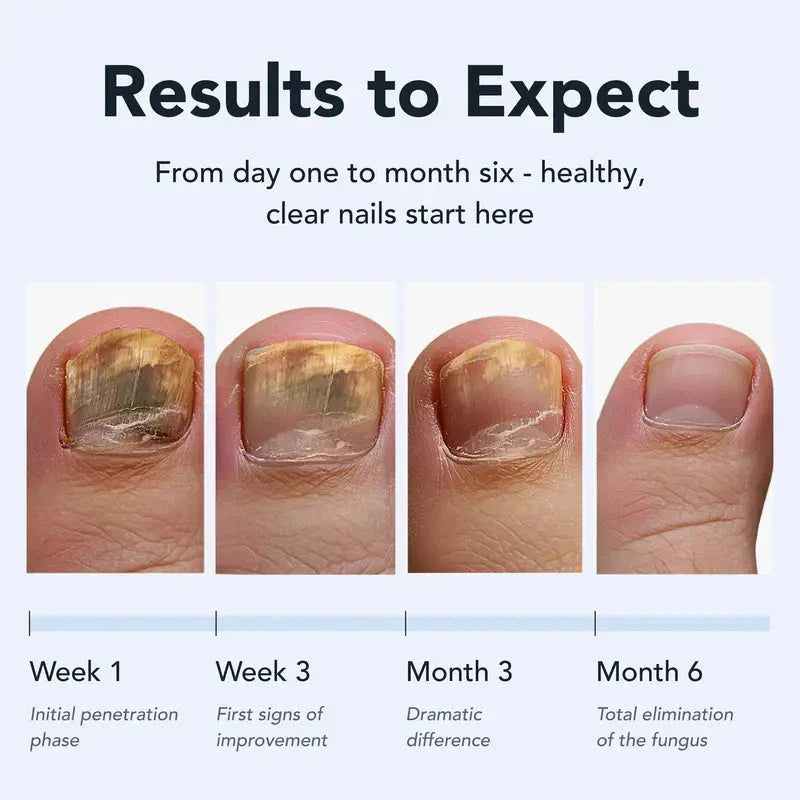 LOVILDS™  Toenail Antifungal Pen - UNDECYLENIC ACID 25% - Daily Solution for Brittle & Thickened Nails
