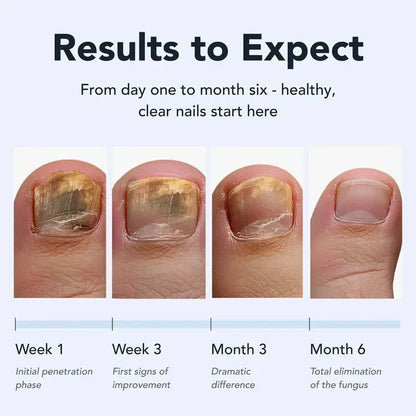 LOVILDS™  Toenail Antifungal Pen - UNDECYLENIC ACID 25% - Daily Solution for Brittle & Thickened Nails