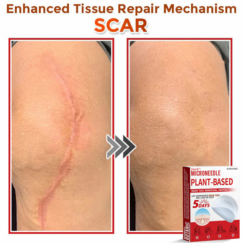 💯Juxek™ MicroNeedle Plant-based Skin Tag Removal Patch 🇺🇸 Made in the USA