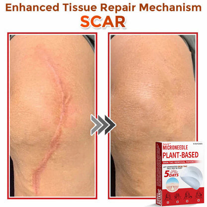 💯Juxek™ MicroNeedle Plant-based Skin Tag Removal Patch 🇺🇸 Made in the USA