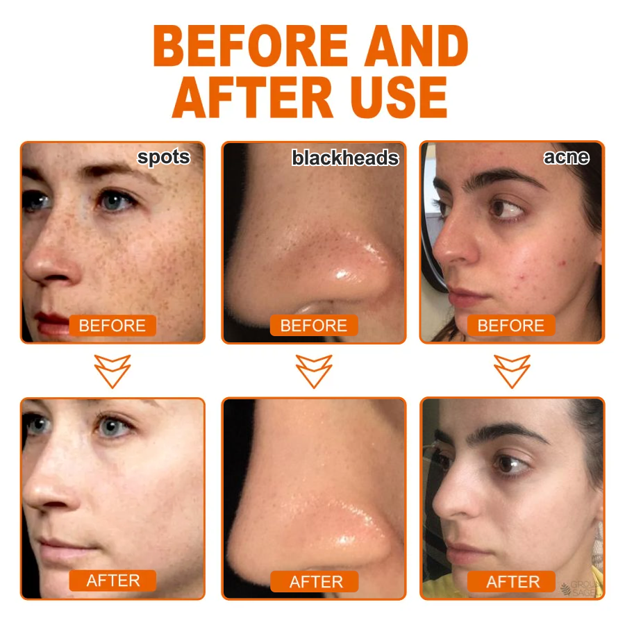 🔥[Official Brand Store] BBOJI™ Herbal Spots Peel-Off Facial Mask