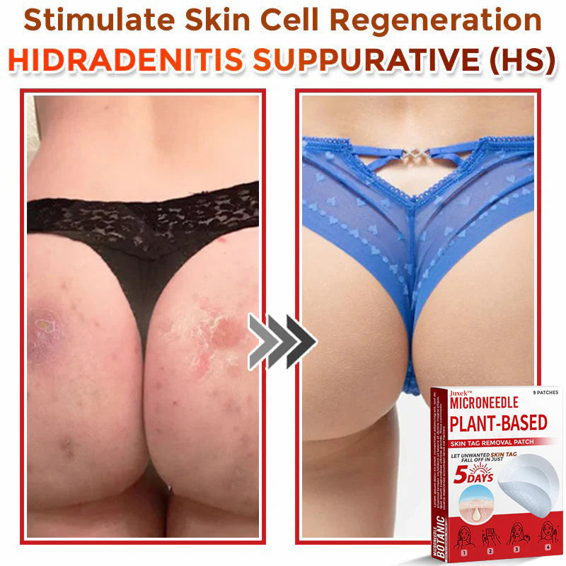 💯Juxek™ MicroNeedle Plant-based Skin Tag Removal Patch 🇺🇸 Made in the USA