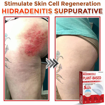 💯Juxek™ MicroNeedle Plant-based Skin Tag Removal Patch 🇺🇸 Made in the USA