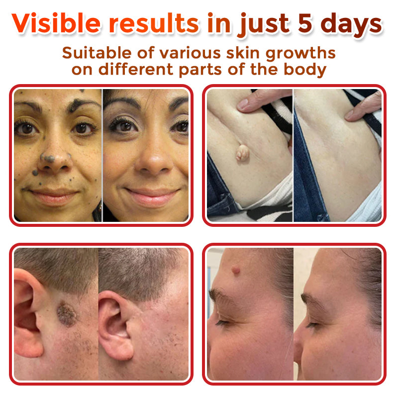 💯Juxek™ MicroNeedle Plant-based Skin Tag Removal Patch 🇺🇸 Made in the USA